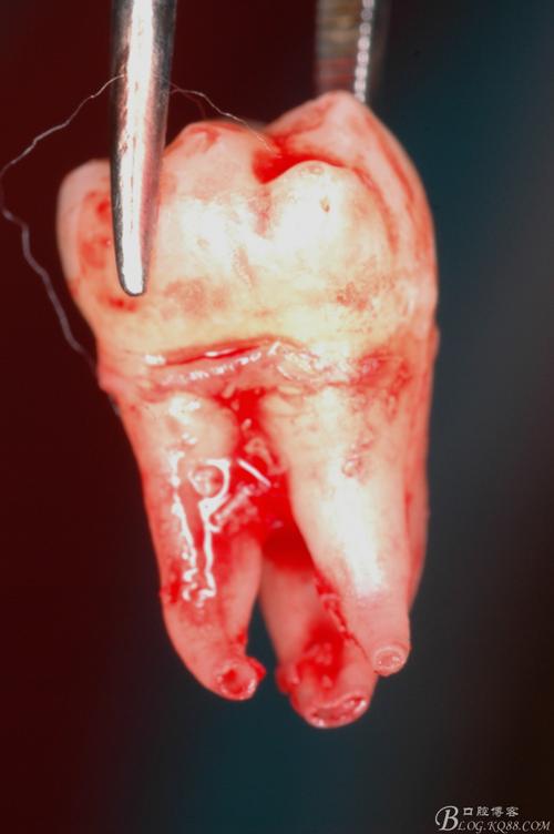 向远中弯曲的牙根.