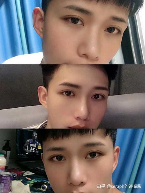 求推荐昆明做双眼皮自然的医生和医院.谢谢?