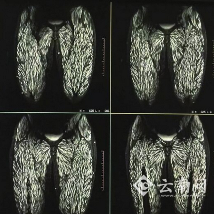 腿部 白点就是感染的寄生虫 省一院供图