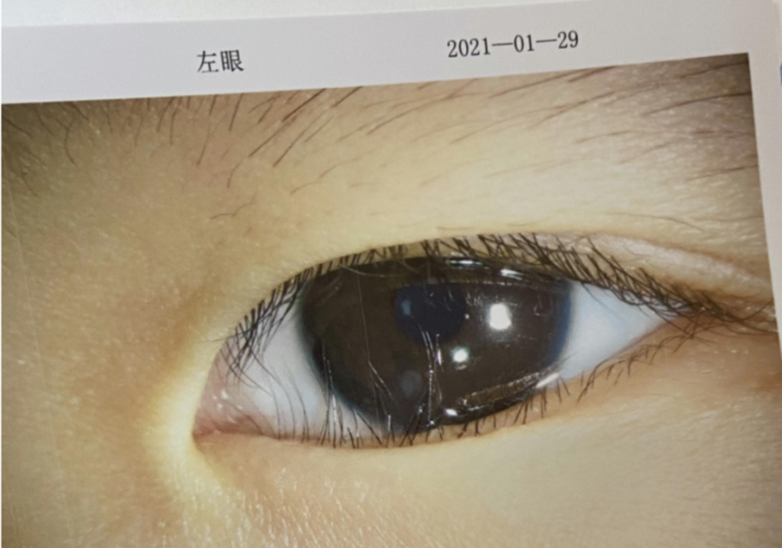 娃的睫毛竟然把自己的眼角膜给戳坏了,究竟是怎么回事