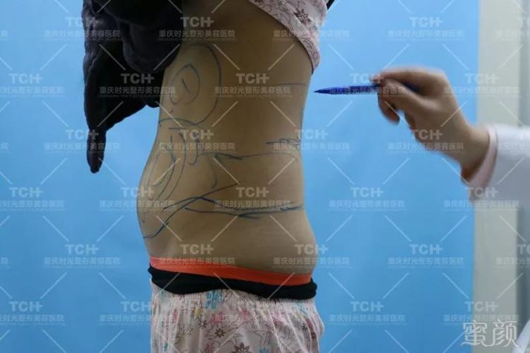 腰腹环吸,大腿环吸