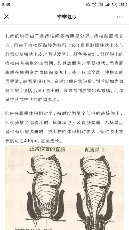 带您认识脱肛(上):内痔脱出与直肠脱垂的区别