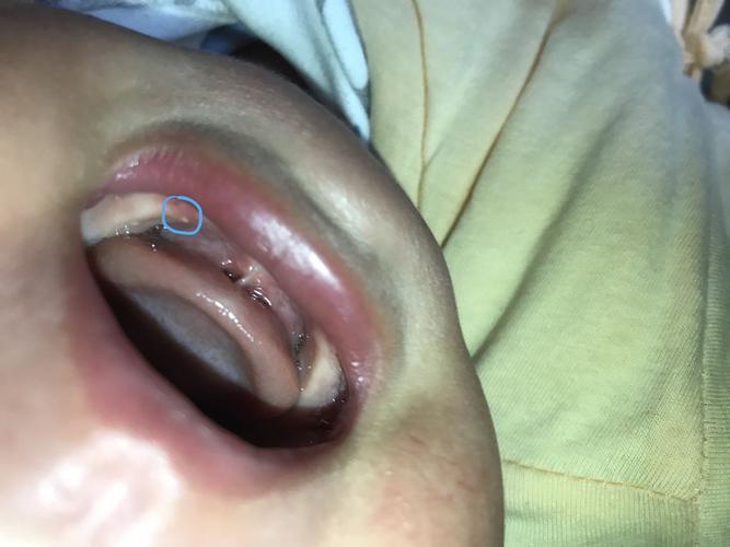 儿子四个月,牙龈上有白色的小泡点,是什么