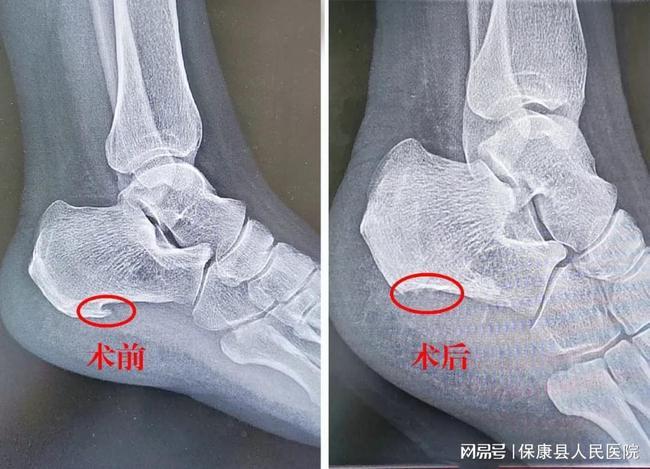 保康县人民医院成功开展首例关节镜下微创治疗跟痛症|骨刺|手术_网易