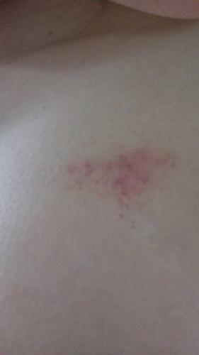 最近身上总是出现这种类似刮痧的红点出来,是什么问题