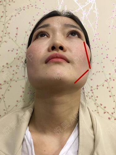 100天脱胎换骨!颧骨颧弓 下颌角综合整形