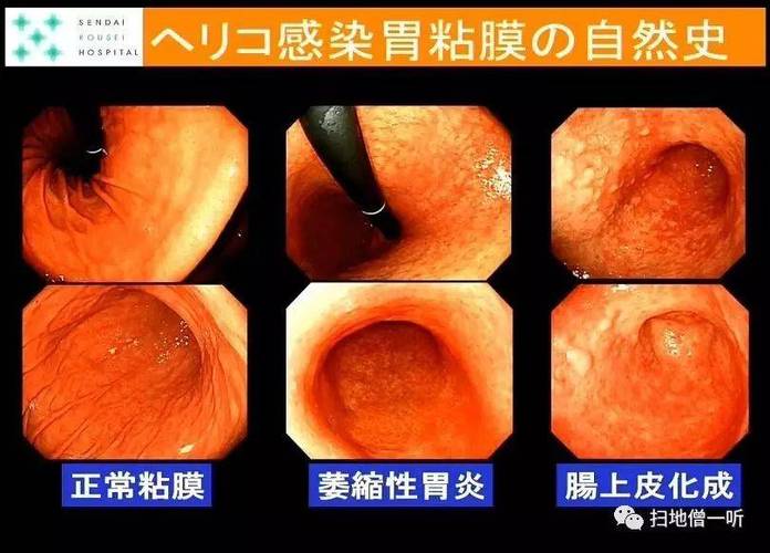 幽门螺杆菌感染后的自然病史历经萎缩性胃炎,肠上皮化生等