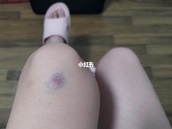 为什么膝盖一直会有莫名其妙的淤青_医疗健康_医疗