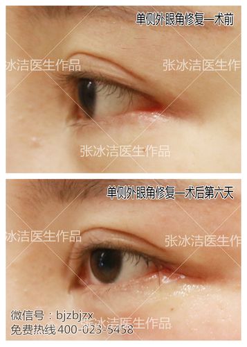 外眼角做成这样要注意