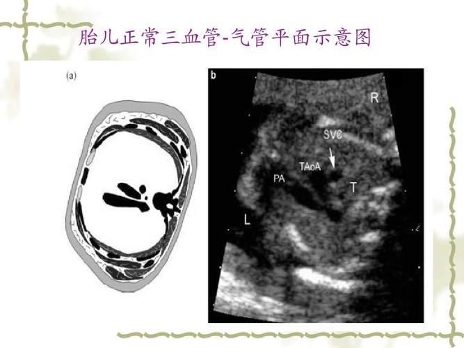 三血管-气管切面在胎儿心脏畸形筛查中的应用ppt