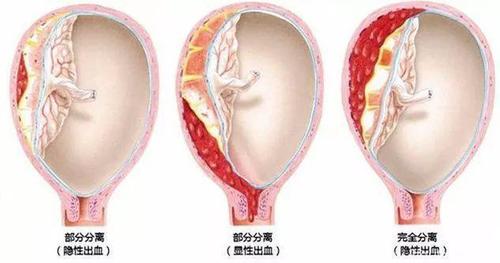 abruption)指妊娠20周后正常位置的胎盘在胎儿娩出前,部分或全部从