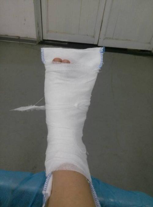 我的小脚趾骨裂了,不打石膏能自愈吗?