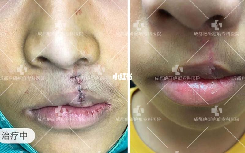 拯救嘴唇畸形,释放自由天性! _疤痕_美妆_医美