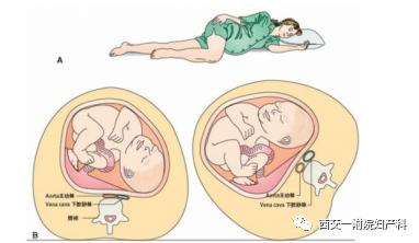 中晚孕期为什么要左侧卧位?