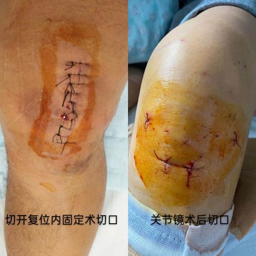 关节镜手术_小切口解决大问题