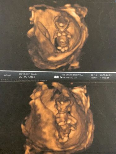 四维彩超_四维猜男女_母婴_孕产经验