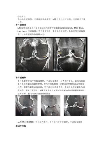 膝关节半月板病变的核磁共振检查的诊断与鉴别