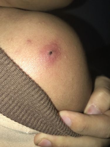 疖子长成这样了 摸点吃点什么药好的比较快