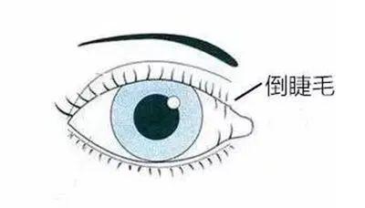 睫毛倒着长是怎么回事应该怎么办