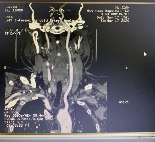 许建-右侧颈内动脉虹吸段重度狭窄