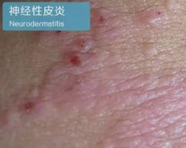 神经性皮炎是生活中比较常见的皮肤病,很容易反复,给患者带来很多