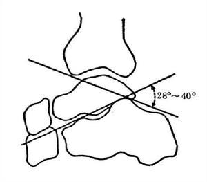 跟骨结节关节角