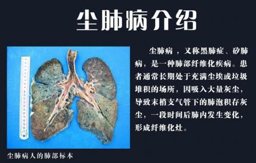85%以上都是尘肺病,可防不易治,只能早发现早治疗