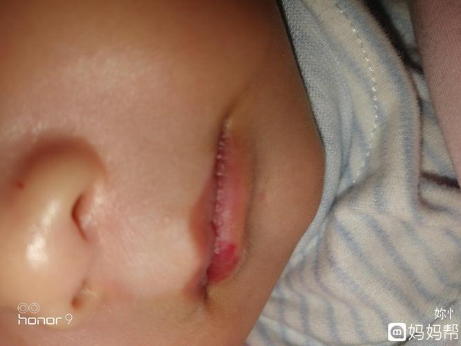 宝宝嘴唇内侧血管瘤跑了七家医院了医生