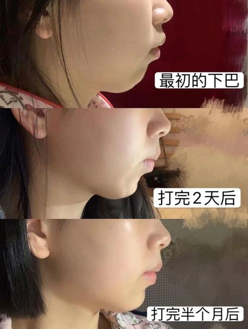 特别是 下巴短小的姐妹,做颏肌放松可能会有意想不到的效果哦