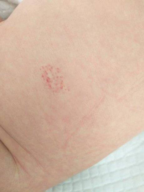 相关搜索 皮下出血点 毛细血管扩张症 血管痣 紫癜 手指上有小红点