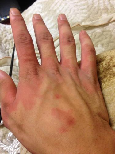 请问这是怎么啦…是酒精过敏嘛