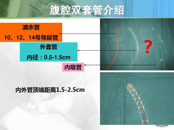 肠瘘合并腹腔感染病人的护理ppt