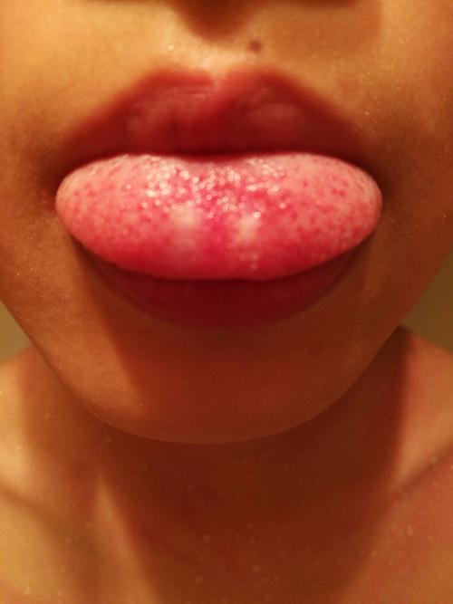 舌尖上开始有小白点后来变成白斑