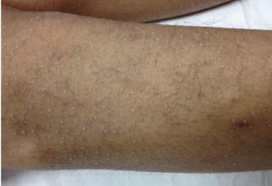 今日病例:前胸及腋窝角化性绒毛状丘疹