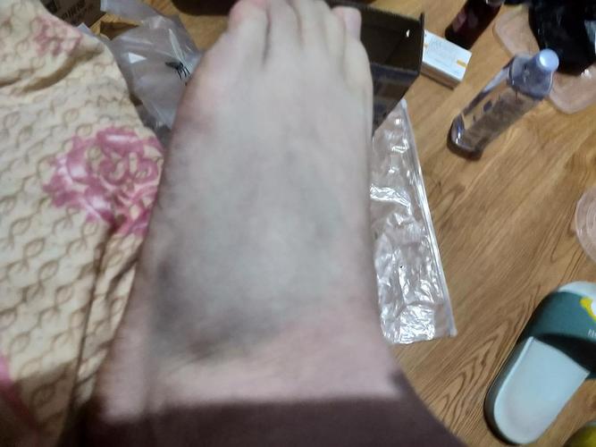 我把脚扭了