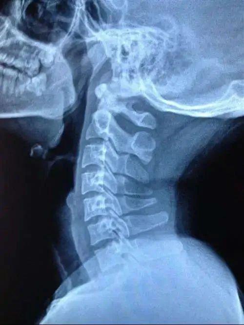 拿什么拯救孩子的颈椎