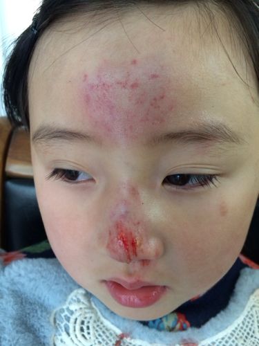 刚刚骑自行车摔倒的会不会伤到骨头