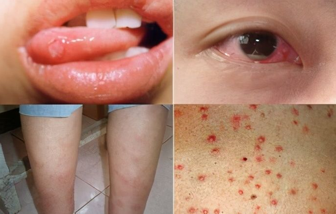 白塞病怎么辨别?