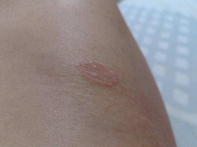 身上起了个癣,不知什么病?也不疼也不痒,请高手鉴定一下.