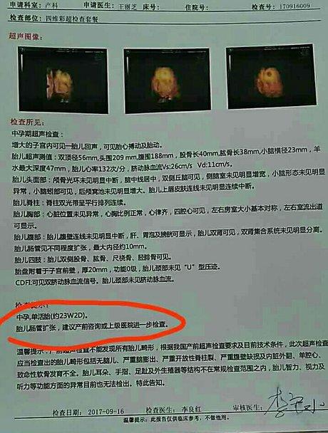 24周四维彩超检查到胎儿 肠管扩张10mm,有什