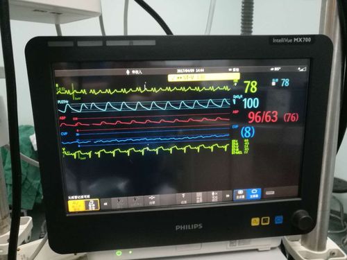 手术后心电图,窦性心率,率齐,术毕转重症监护室继续治疗
