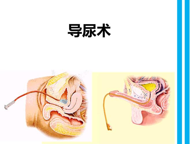 导尿