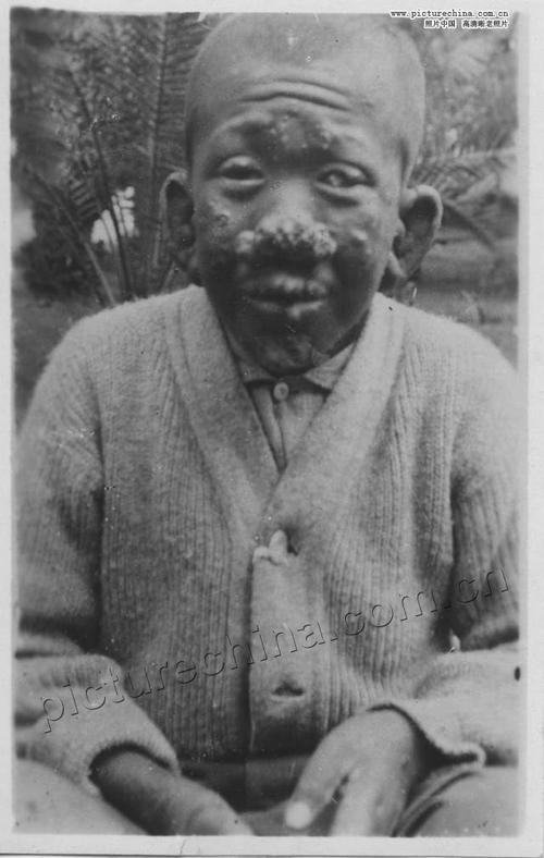 恐怖!麻风病人老照片