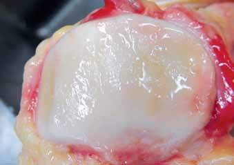 手术技术:微创方法取髌骨上入路胫骨髓内钉