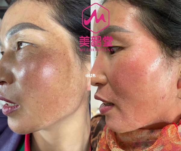 使用铅汞激素产品形成大花脸_激素脸_肌肤健康_脱屑_美妆_护肤