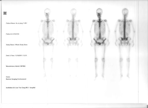 求影像核医学专业的医生帮看一下我母亲的spect(全身骨扫描)结果,图片