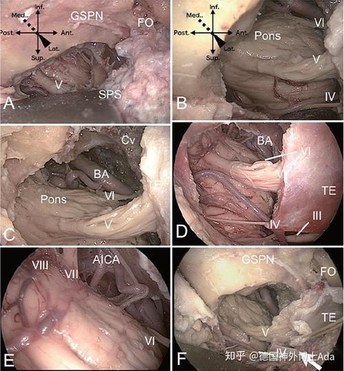 岩斜区脑膜瘤开颅还是内镜kawase教授深入剖析岩斜区脑膜瘤kawase入路