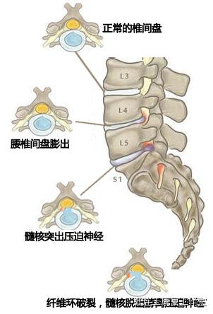 腰椎间盘突出是怎么回事呢?