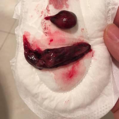 先兆流产,腹痛一天流出来的东西,其中有孕囊