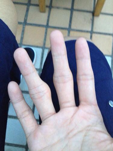 问:高一的时候不懂事,总是扳手指的关节,导致现在手指关节肿大(如图)